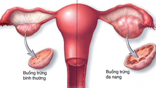 OvaQ1 điều trị đa nang